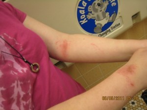 Photo taken by Maryann Duzan of injuries to Sara's arms, which Maryann claims were the result of physical restraints used on her at the Kolburne School in May 2011.