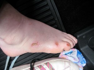 Photo taken by Maryann of injuries to Sara's right foot, allegedly resulting from restraints used on her at the Kolburne School in May 2011.